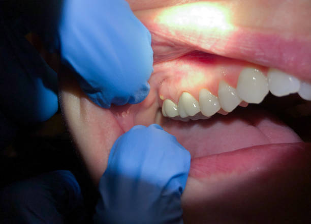Best Knocked-Out Tooth (Avulsed Tooth) Treatment in Big Le, AK